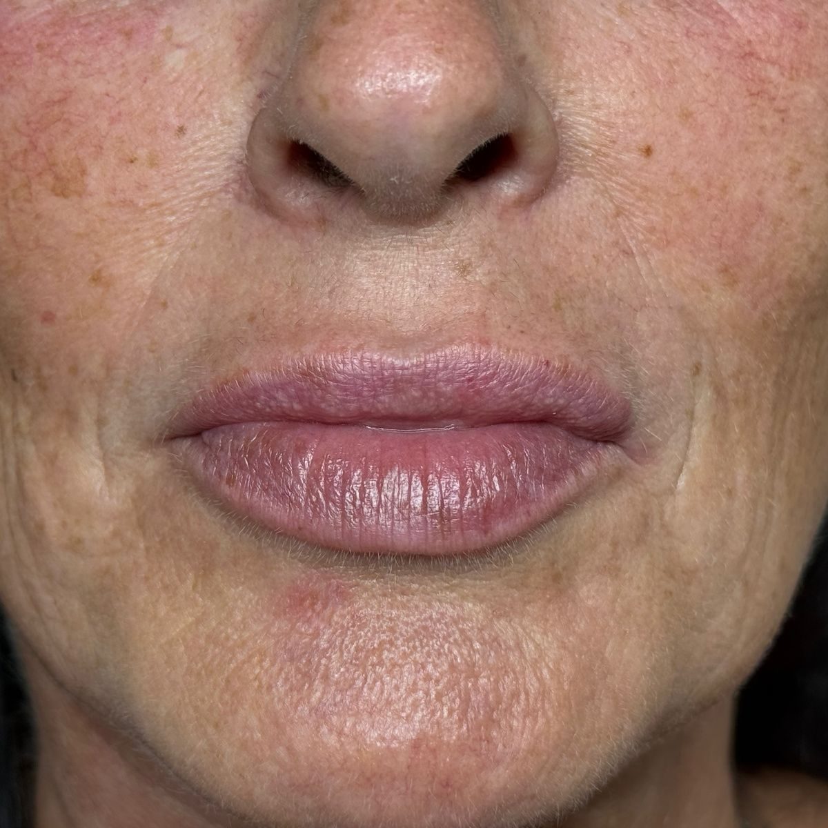 Before treatment, lesley